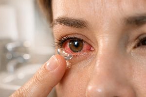Contact Lens Infections: Causes and Solutions