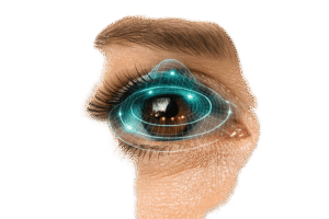 Why Wavefront-Guided LASIK Speeds Up Recovery